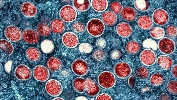 A colorized transmission electron microscopic image of monkeypox virus particles, found within an infected cell